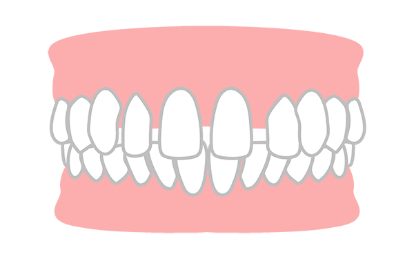 空隙歯列